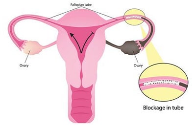 اختلال در تخمک گذاری